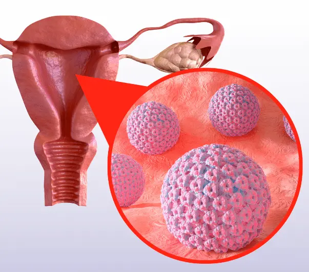 HPV زگیل تناسلی