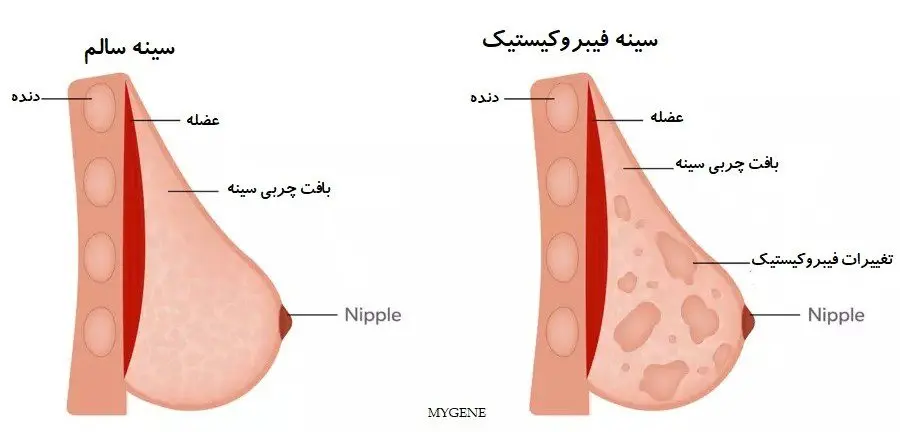 سینه فیبروکیستیک