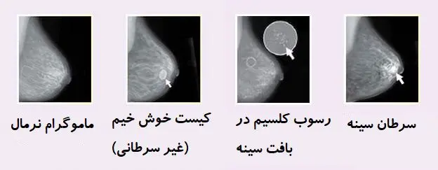 کیست خوش خیم و سرطان