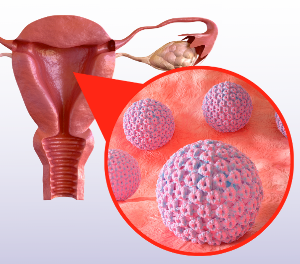 HPV زگیل تناسلی