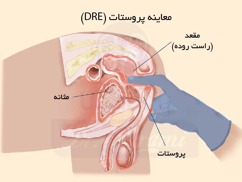 معاینه پروستات