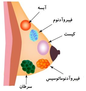 انواع کیست