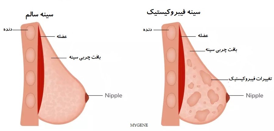 سینه فیبروکیستیک
