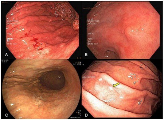 عکس سرطان معده